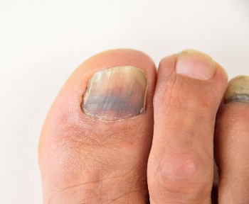 Black toenail injury close up Big toe lifter nail bed Stock Photo  Alamy