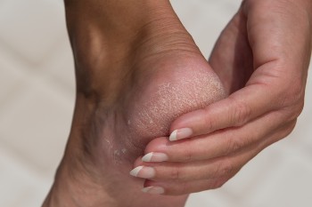 Get Rid of Dry or Cracked Heels  North Florida Foot & Ankle Center