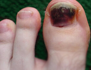 Black Toenail Treatment in North Seattle | Foot and Ankle Center of Lake  City