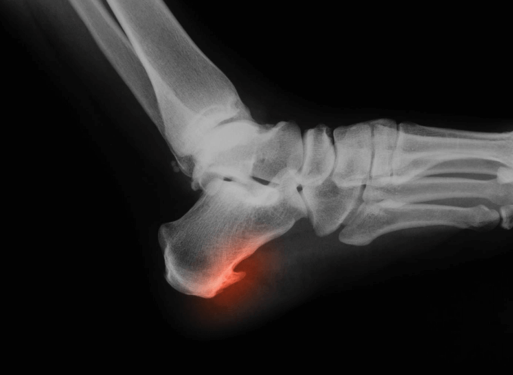 How Is A Bone Spur Removal Procedure Done?-gemektower.com.vn