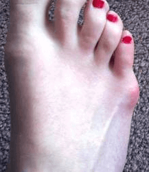 What's That Bump on the Outside of My Little Toe? - Tailor's Bunion