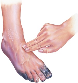 Antibiotikumok a láb gangrénához - Elemzések - November