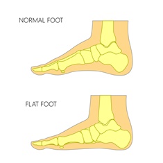 Flatfoot and Collapsed Arches | Austin Foot and Ankle Specialists