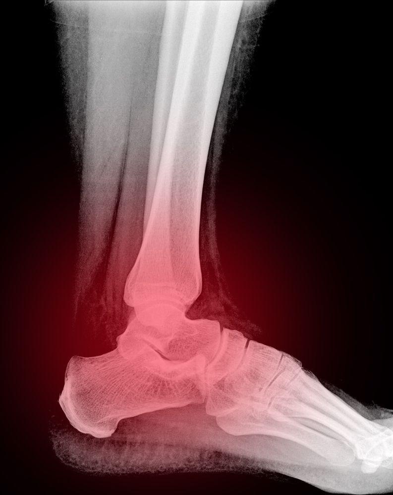Sever's Disease (Heel Pain) - OrthoInfo - AAOS