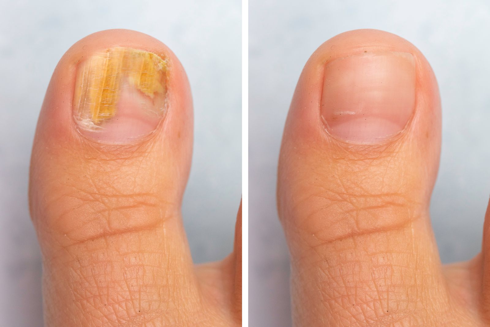Nail Fungus: real advice from real people for healthy toenails and  fingernails