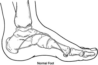 Flexible Flat feet | Experienced Albuquerque Podiatrist | New Mexico ...