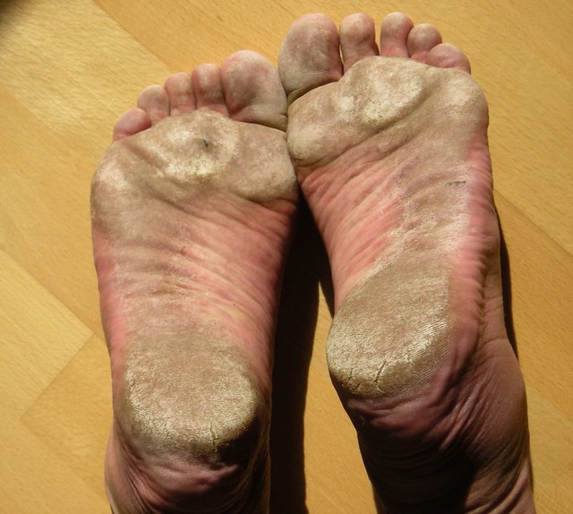 crusty feet