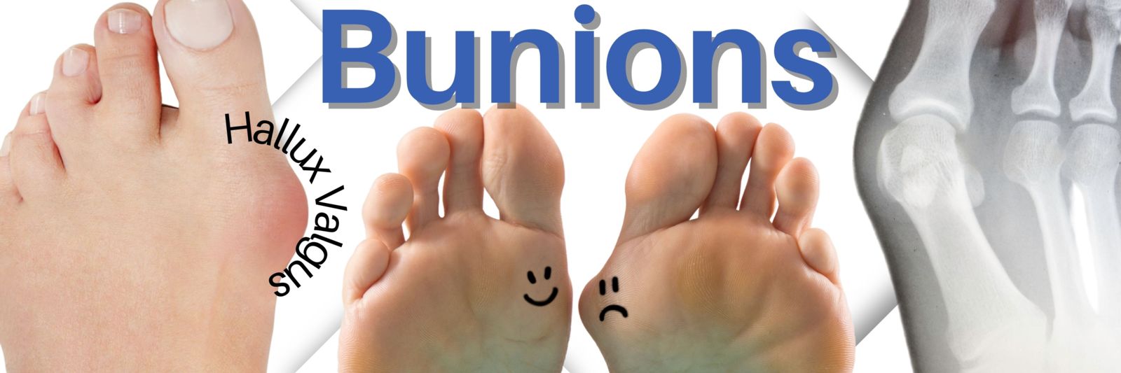 Got Big Toe Bumps and Lumps? Here's 5 Things You Need to Know
