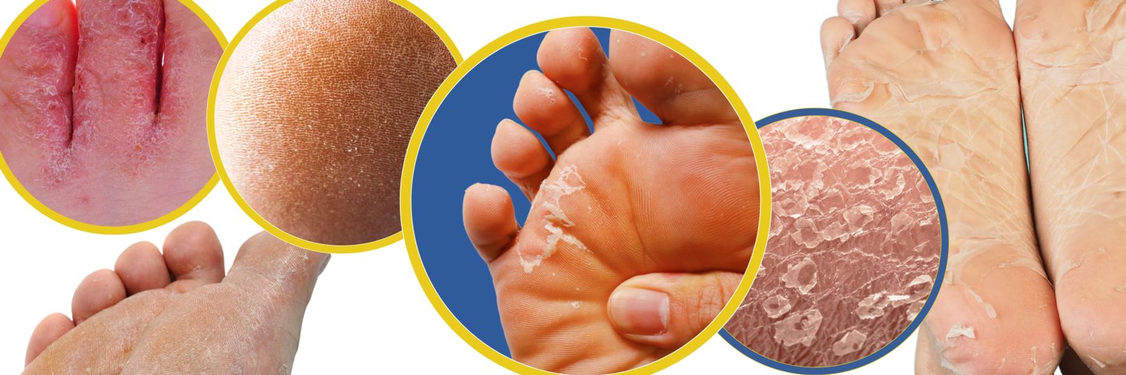 Peeling Feet: Symptoms, Causes, and Treatment