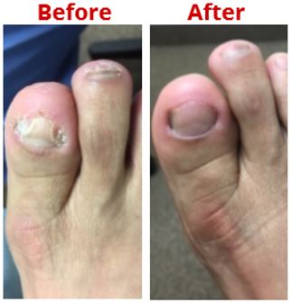 Hiding Your Feet Due To Toenail Fungus | Haro Podiatry & Laser Center