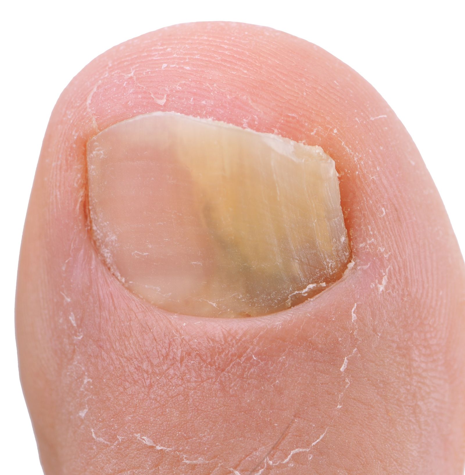 How should a diabetic cut their toenails? - Quora