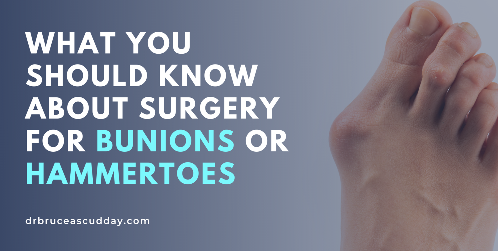 What You Should Know About Surgery for Bunions or Hammertoes | Dr ...
