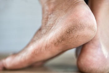 Understanding Heel Fissures and Diabetic Feet