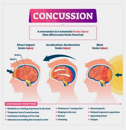 Post-Concussion Syndrome from Accidents in Kansas City