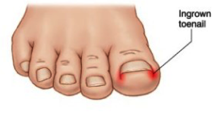 Ingrown Toenails: What? How? Why? | Cornerstone Foot & Ankle