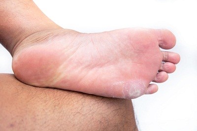cause of dead skin on feet