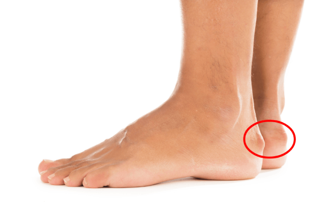 Haglund's Deformity and Your Feet 