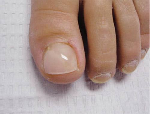 trauma nail treatment