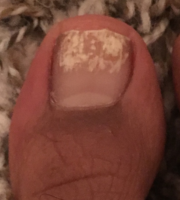 Is it Toenail Fungus? | Foot and Ankle Associates of North Texas, LLP