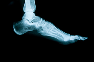 Doodskaak Bestaan rekken How Long to Heal Broken Ankle? | Foot & Ankle Associates of Florida
