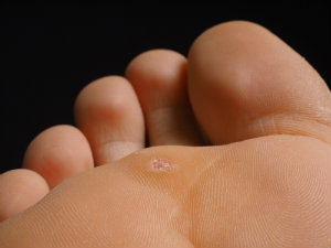wart on foot arch)