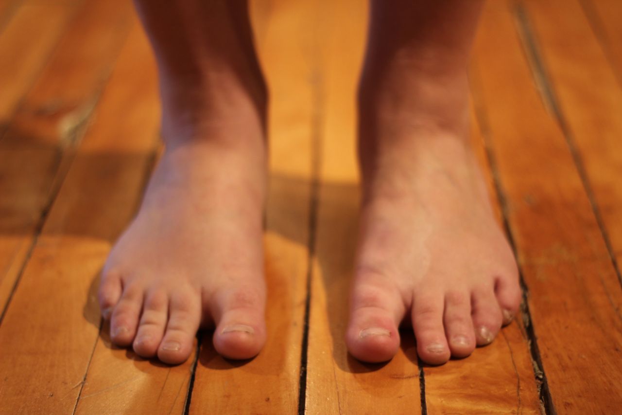 Causes and Treatments for Foot Drop
