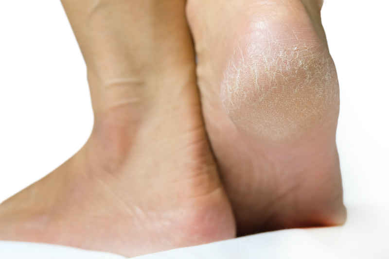 dry feet skin