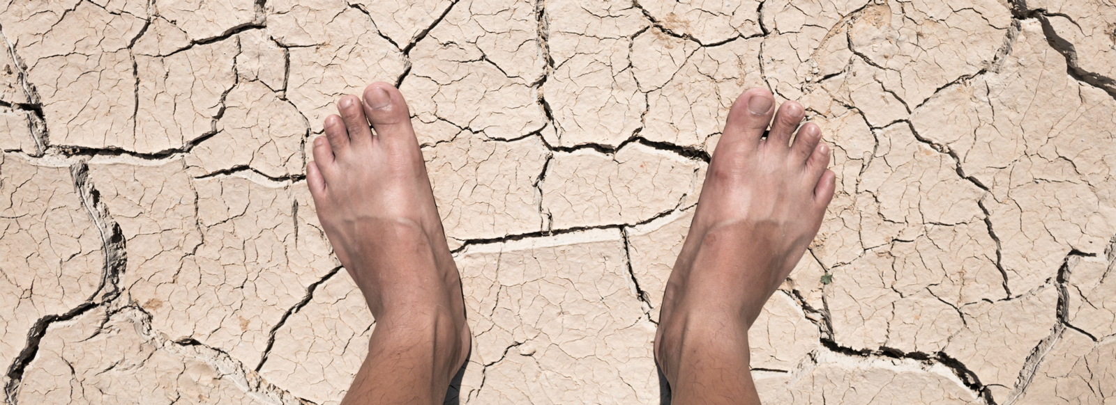 Preventing and Caring for Dry Feet | Advanced Foot & Ankle