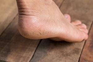 Treating Cracked Heels and Heel Fissures | Martin Foot & Ankle