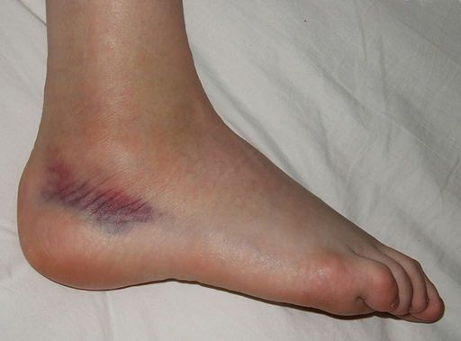 niece Skabelse kalorie Top 4 signs Your Ankle Injury Is Serious | Sol Foot & Ankle Centers