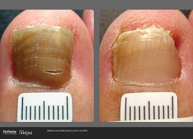 Secondary Onychomycosis Development after Cosmetic Procedure-Case Report